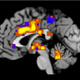 Image for article titled Scientists Succeed In Objectively Measuring Pain